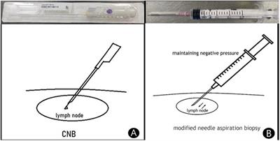 The diagnostic value and safety of modified needle aspiration biopsy for superficial lymphadenectasis